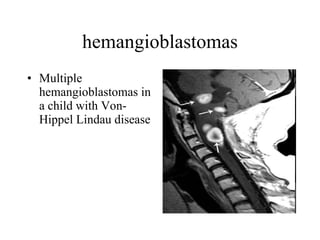 hemangioblastomas Multiple hemangioblastomas in a child with Von-Hippel Lindau disease  