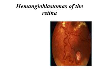 Hemangioblastomas of the retina 