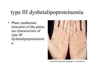 type III dysbetalipoproteinemia Plane xanthomas (macular) of the palms are characteristic of type III dysbetalipoproteinemia.  