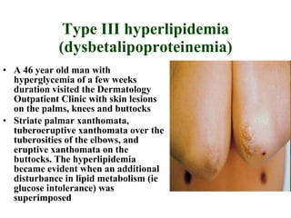 Type III hyperlipidemia (dysbetalipoproteinemia) A 46 year old man with hyperglycemia of a few weeks duration visited the Dermatology Outpatient Clinic with skin lesions on the palms, knees and buttocks Striate palmar xanthomata, tuberoeruptive xanthomata over the tuberosities of the elbows, and eruptive xanthomata on the buttocks. The hyperlipidemia became evident when an additional disturbance in lipid metabolism (ie glucose intolerance) was superimposed  