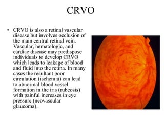 CRVO CRVO is also a retinal vascular disease but involves occlusion of the main central retinal vein. Vascular, hematologic, and cardiac disease may predispose individuals to develop CRVO which leads to leakage of blood and fluid into the retina. In many cases the resultant poor circulation (ischemia) can lead to abnormal blood vessel formation in the iris (rubeosis) with painful increases in eye pressure (neovascular glaucoma).  