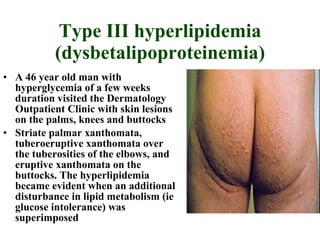 Type III hyperlipidemia (dysbetalipoproteinemia) A 46 year old man with hyperglycemia of a few weeks duration visited the Dermatology Outpatient Clinic with skin lesions on the palms, knees and buttocks Striate palmar xanthomata, tuberoeruptive xanthomata over the tuberosities of the elbows, and eruptive xanthomata on the buttocks. The hyperlipidemia became evident when an additional disturbance in lipid metabolism (ie glucose intolerance) was superimposed  