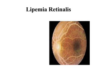 Lipemia Retinalis 
