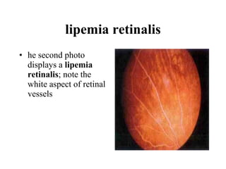 lipemia retinalis he second photo displays a  lipemia retinalis ; note the white aspect of retinal vessels  