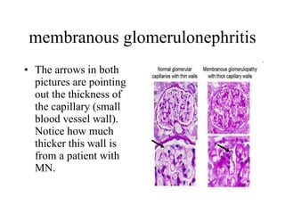 membranous glomerulonephritis The arrows in both pictures are pointing out the thickness of the capillary (small blood vessel wall).  Notice how much thicker this wall is from a patient with MN.  