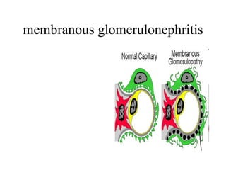 membranous glomerulonephritis 