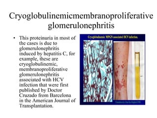 Cryoglobulinemicmembranoproliferative glomerulonephritis This proteinuria in most of the cases is due to glomerulonephritis induced by hepatitis C, for example, these are cryoglobulinemic, membranoproliferative glomerulonephritis associated with HCV infection that were first published by Doctor Cruzado from Barcelona in the American Journal of Transplantation.  
