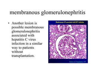 membranous glomerulonephritis Another lesion is possible membranous glomerulonephritis associated with hepatitis C virus infection in a similar way to patients without transplantation.  