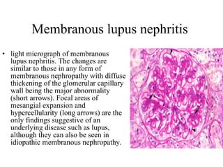 Membranous lupus nephritis  light micrograph of membranous lupus nephritis. The changes are similar to those in any form of membranous nephropathy with diffuse thickening of the glomerular capillary wall being the major abnormality (short arrows). Focal areas of mesangial expansion and hypercellularity (long arrows) are the only findings suggestive of an underlying disease such as lupus, although they can also be seen in idiopathic membranous nephropathy.  