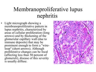 Membranoproliferative lupus nephritis  Light micrograph showing a membranoproliferative pattern in lupus nephritis, characterized by areas of cellular proliferation (long arrows) and by thickening of the glomerular capillary wall (due to immune deposits) that may be prominent enough to form a "wire-loop" (short arrows). Although proliferative changes can be focal (affecting less than 50 percent of glomeruli), disease of this severity is usually diffuse.  
