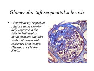 Glomerular tuft segmental sclerosis Glomerular tuft segmental sclerosis in the superior half; segments in the inferior half display mesangium and capillary walls and lumens with conserved architecture. (Masson’s trichrome, X400).   