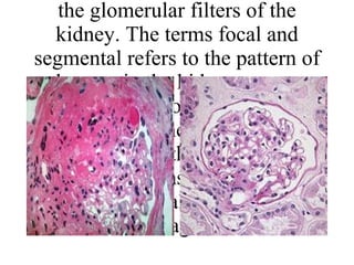 Focal Segmental Glomerulosclerosis Focal segmental glomerulosclerosis or FSGS is a disease that causes urinary loss of protein and eventual scarring of the glomerular filters of the kidney. The terms focal and segmental refers to the pattern of damage in the kidney as seen under a microscope. Focal means that some of the glomeruli are scarred while others are normal. Segmental means that only a part of an individual glomerulus is damaged.  