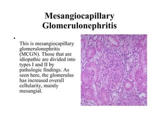 Mesangiocapillary Glomerulonephritis This is mesangiocapillary glomerulonephritis (MCGN). Those that are idiopathic are divided into types I and II by pathologic findings. As seen here, the glomerulus has increased overall cellularity, mainly mesangial.    