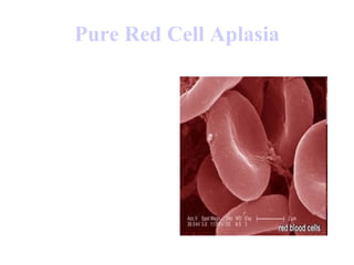 Pure Red Cell  Aplasia 