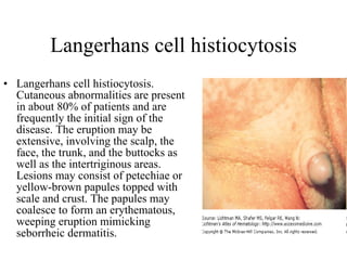Langerhans cell histiocytosis Langerhans cell histiocytosis. Cutaneous abnormalities are present in about 80% of patients and are frequently the initial sign of the disease. The eruption may be extensive, involving the scalp, the face, the trunk, and the buttocks as well as the intertriginous areas. Lesions may consist of petechiae or yellow-brown papules topped with scale and crust. The papules may coalesce to form an erythematous, weeping eruption mimicking seborrheic dermatitis.  