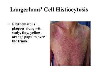 Langerhans' Cell Histiocytosis Erythematous plaques along with scaly, tiny, yellow-orange papules over the trunk.   