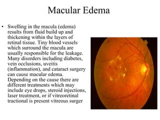 Macular Edema  Swelling in the macula (edema) results from fluid build up and thickening within the layers of retinal tissue. Tiny blood vessels which surround the macula are usually responsible for the leakage. Many disorders including diabetes, vein occlusions, uveitis (inflammation), and cataract surgery can cause macular edema. Depending on the cause there are different treatments which may include eye drops, steroid injections, laser treatment, or if vitreoretinal tractional is present vitreous surger  