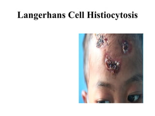 Langerhans Cell Histiocytosis 