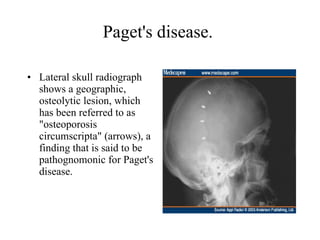 Paget's disease.  Lateral skull radiograph shows a geographic, osteolytic lesion, which has been referred to as "osteoporosis circumscripta" (arrows), a finding that is said to be pathognomonic for Paget's disease.  