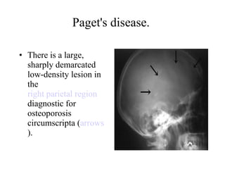 Paget's disease.  There is a large, sharply demarcated low-density lesion in the  right parietal region  diagnostic for osteoporosis circumscripta ( arrows ).  
