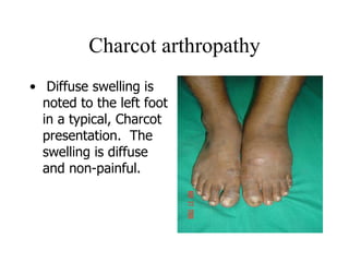 Charcot arthropathy   Diffuse swelling is noted to the left foot in a typical, Charcot presentation.  The swelling is diffuse and non-painful.   