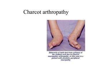 Charcot arthropathy 