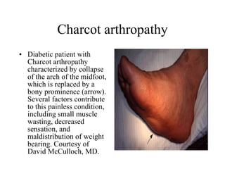 Charcot arthropathy Diabetic patient with Charcot arthropathy characterized by collapse of the arch of the midfoot, which is replaced by a bony prominence (arrow). Several factors contribute to this painless condition, including small muscle wasting, decreased sensation, and maldistribution of weight bearing. Courtesy of David McCulloch, MD.  
