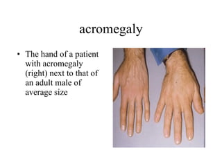 acromegaly The hand of a patient with acromegaly (right) next to that of an adult male of average size  
