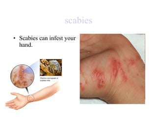 scabies Scabies can infest your hand.  