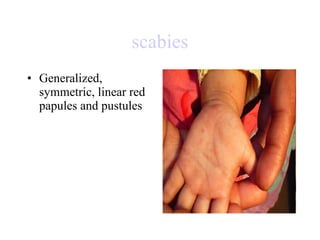 scabies Generalized, symmetric, linear red papules and pustules  