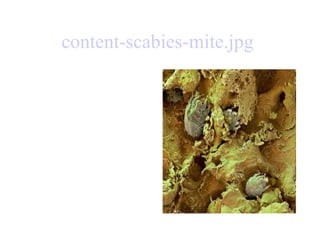 content-scabies- mite.jpg   