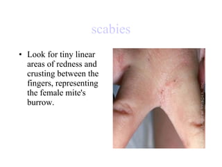 scabies Look for tiny linear areas of redness and crusting between the fingers, representing the female mite's burrow.  