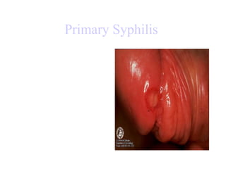 Primary Syphilis   