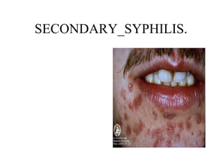 SECONDARY_SYPHILIS. 