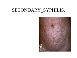 SECONDARY_SYPHILIS. 