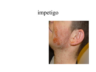 impetigo 