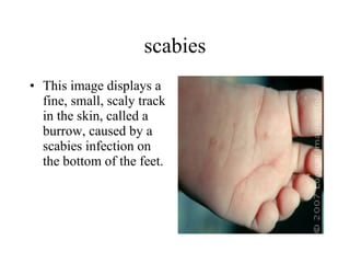 scabies This image displays a fine, small, scaly track in the skin, called a burrow, caused by a scabies infection on the bottom of the feet.  