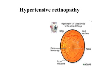 Hypertensive retinopathy 