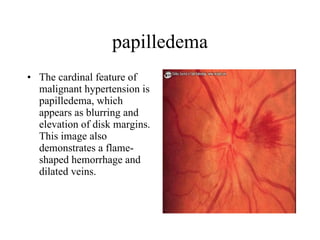 papilledema The cardinal feature of malignant hypertension is papilledema, which appears as blurring and elevation of disk margins. This image also demonstrates a flame-shaped hemorrhage and dilated veins.  
