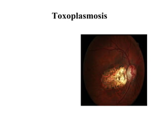 Toxoplasmosis 