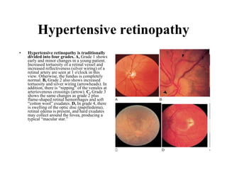 Hypertensive retinopathy Hypertensive retinopathy is traditionally divided into four grades. A,  Grade 1 shows early and minor changes in a young patient. Increased tortuosity of a retinal vessel and increased reflectiveness (silver wiring) of a retinal artery are seen at 1 o'clock in this view. Otherwise, the fundus is completely normal.  B,  Grade 2 also shows increased tortuosity and silver wiring (arrowheads). In addition, there is “nipping” of the venules at arteriovenous crossings (arrow).  C,  Grade 3 shows the same changes as grade 2 plus flame-shaped retinal hemorrhages and soft “cotton wool” exudates.  D,  In grade 4, there is swelling of the optic disc (papilledema), retinal edema is present, and hard exudates may collect around the fovea, producing a typical “macular star.”  