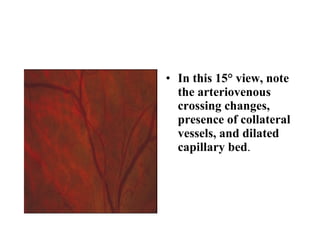 In this 15° view, note the arteriovenous crossing changes, presence of collateral vessels, and dilated capillary bed .  