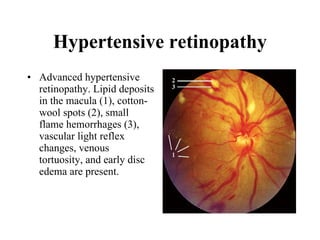 Hypertensive retinopathy Advanced hypertensive retinopathy. Lipid deposits in the macula (1), cotton-wool spots (2), small flame hemorrhages (3), vascular light reflex changes, venous tortuosity, and early disc edema are present.   