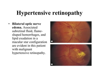 Hypertensive retinopathy Bilateral optic nerve edema.  Associated subretinal fluid, flame-shaped hemorrhages, and lipid exudation in a macular star configuration are evident in this patient with malignant hypertensive retinopathy.  