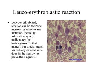 Leuco-erythroblastic reaction Leuco-erythroblastic reaction can be the bone marrow response to any irritation, including infiltration by any malignancy (or histiocytosis for that matter), but special stains for histiocytes need to be done in the marrow to prove the diagnosis. 