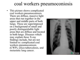 coal workers pneumoconiosis This picture shows complicated coal workers pneumoconiosis. There are diffuse, massive light areas that run together in the upper and middle parts of both lungs. These are superimposed on a background of small and poorly distinguishable light areas that are diffuse and located in both lungs. Diseases which may explain these X-ray findings include, but are not limited to: complicated coal workers pneumoconiosis (CWP), silico-tuberculosis, and metastatic lung cancer.  