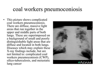 coal workers pneumoconiosis This picture shows complicated coal workers pneumoconiosis. There are diffuse, massive light areas that run together in the upper and middle parts of both lungs. These are superimposed on a background of small and poorly distinguishable light areas that are diffuse and located in both lungs. Diseases which may explain these X-ray findings include, but are not limited to: complicated coal workers pneumoconiosis (CWP), silico-tuberculosis, and metastatic lung cancer   