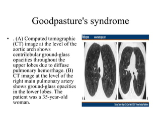 Goodpasture's syndrome . (A) Computed tomographic (CT) image at the level of the aortic arch shows centrilobular ground-glass opacities throughout the upper lobes due to diffuse pulmonary hemorrhage. (B) CT image at the level of the right main pulmonary artery shows ground-glass opacities in the lower lobes. The patient was a 35-year-old woman.  