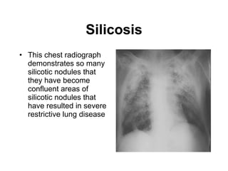 Silicosis This chest radiograph demonstrates so many silicotic nodules that they have become confluent areas of silicotic nodules that have resulted in severe restrictive lung disease   