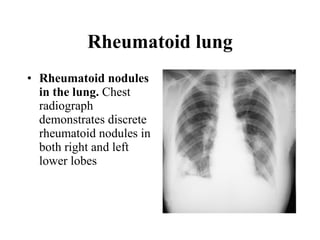 Rheumatoid lung Rheumatoid nodules in the lung.  Chest radiograph demonstrates discrete rheumatoid nodules in both right and left lower lobes  